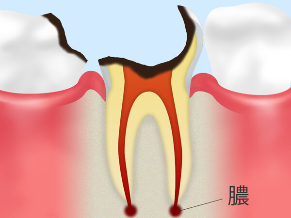 C4：歯冠が崩壊した虫歯